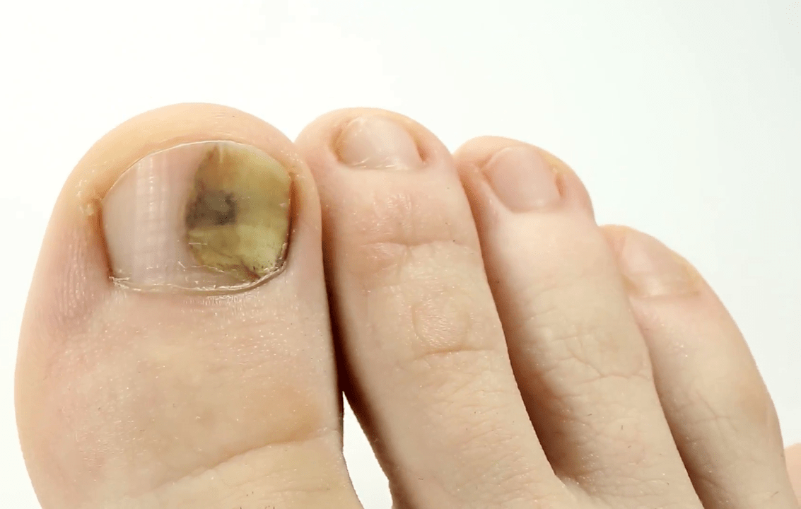 infecție fungică a unghiilor