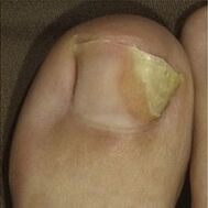 ciuperca unghiilor de la picioare foto 2
