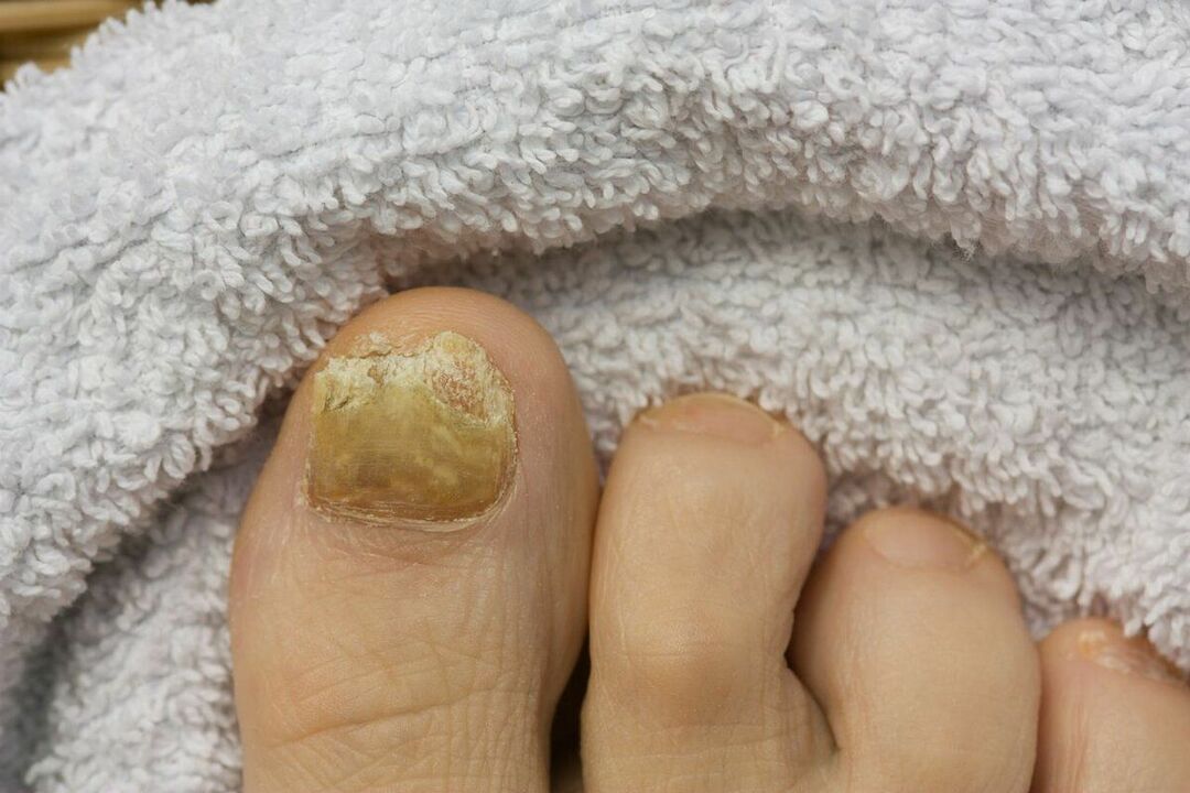 cauzele ciupercii unghiilor de la picioare