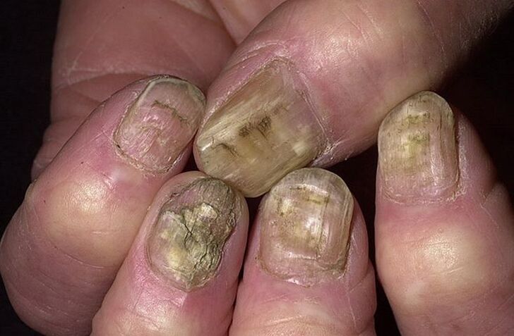 Deformarea, separarea și prăbușirea unghiilor din cauza ciupercilor