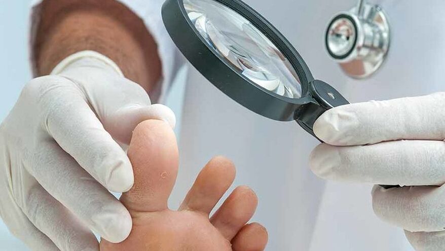 Diagnosticul ciupercii unghiilor de la picioare este efectuat de un dermatolog