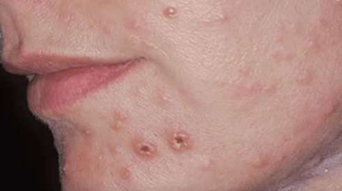 Infecție fungică a pielii de pe față