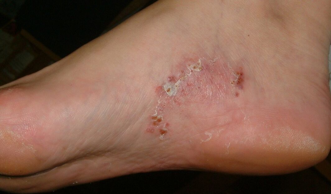 Manifestări ale unei infecții fungice la picior